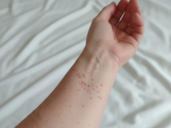 Secretaría de Salud confirma primer caso de sarampión en Puebla